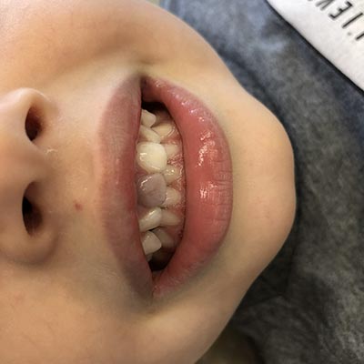 dente escurecido depois de um trauma