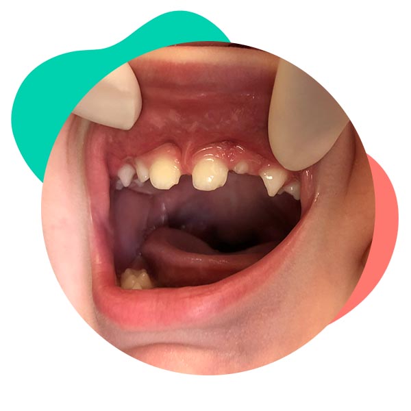 Trauma dentário